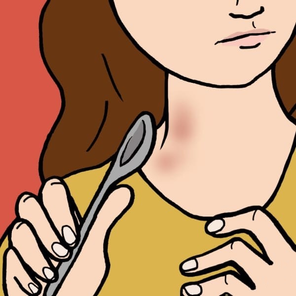 How To Get Rid Of A Hickey